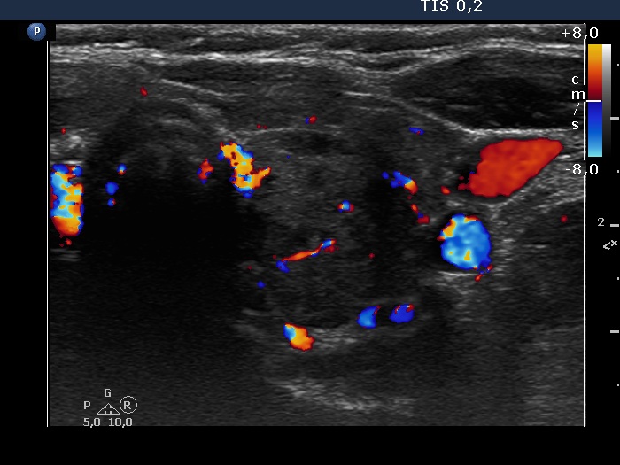 Right lobe, longitudinal scan