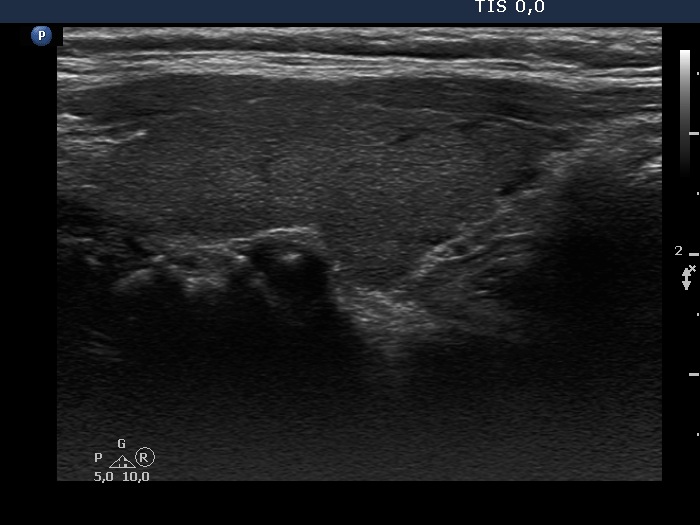 Right lobe, longitudinal scan