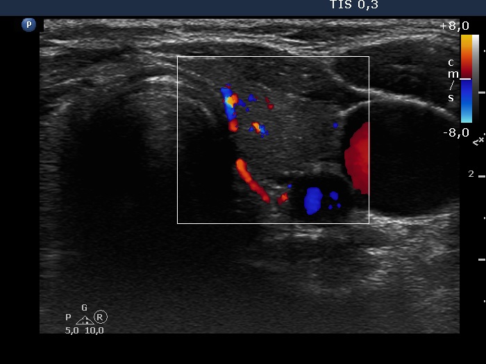 Right lobe, longitudinal scan