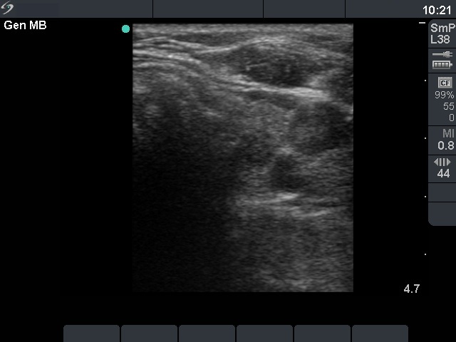 Right lobe, horizontal view