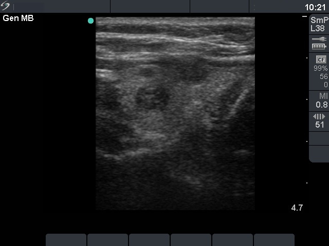 Right lobe, horizontal view