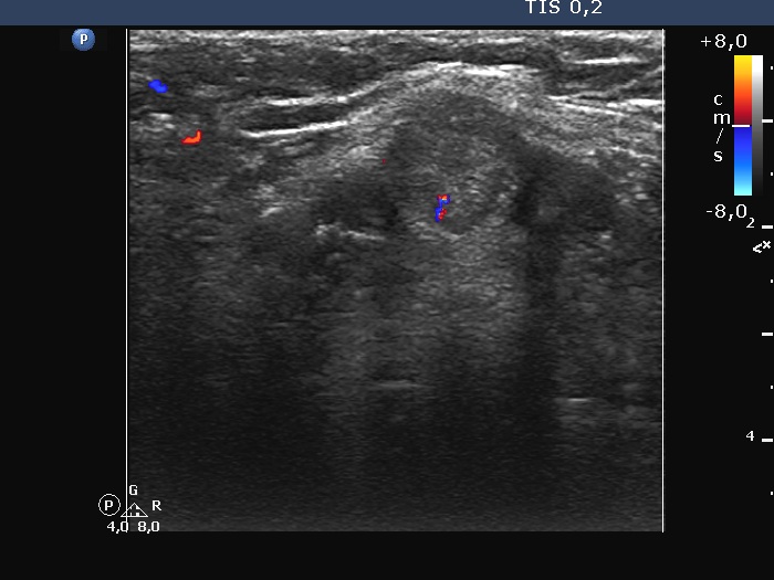 Right lobe, longitudinal scan