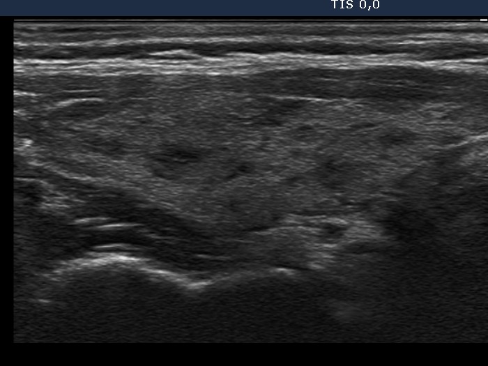 Right lobe, longitudinal scan