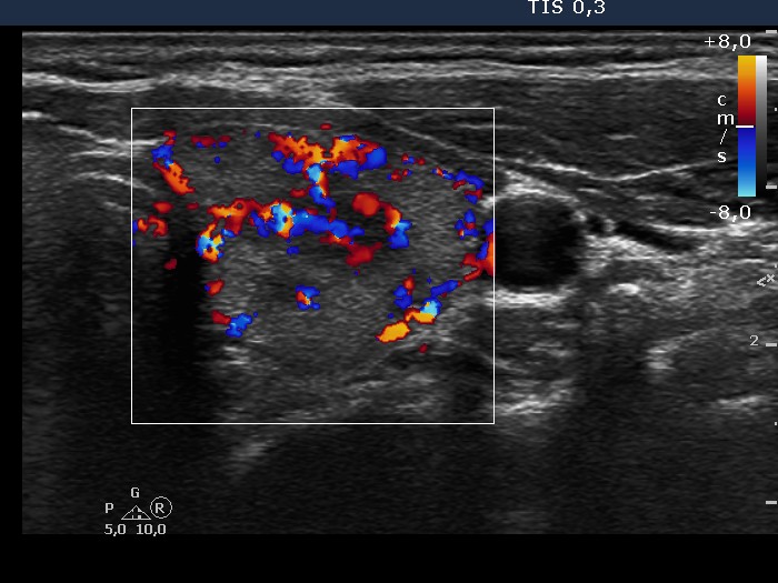 Right lobe, longitudinal scan