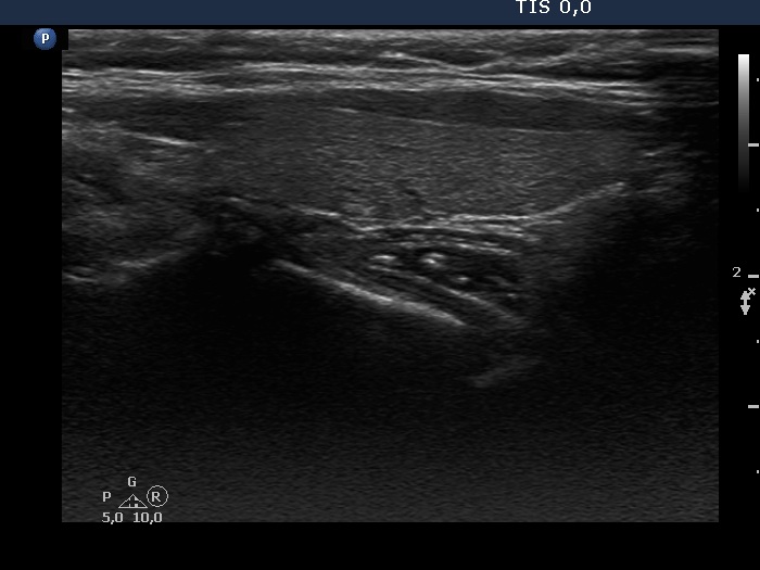 Right lobe, longitudinal scan