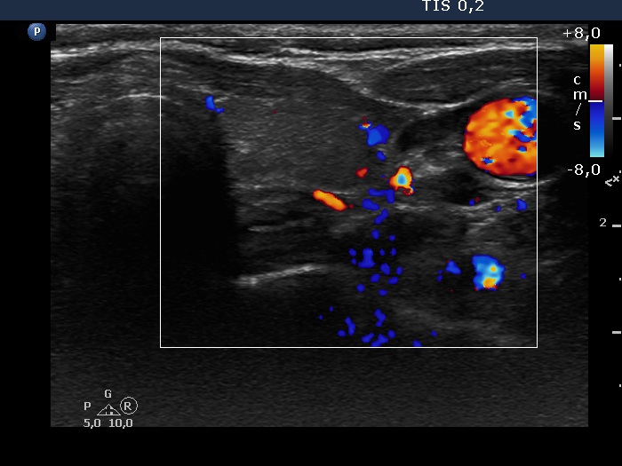 Right lobe, longitudinal scan