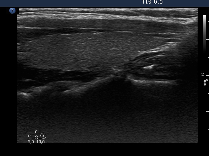 Right lobe, longitudinal scan