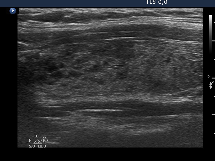 Right lobe, longitudinal scan