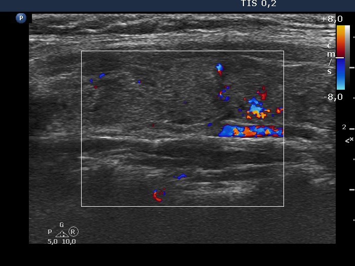 Right lobe, longitudinal scan