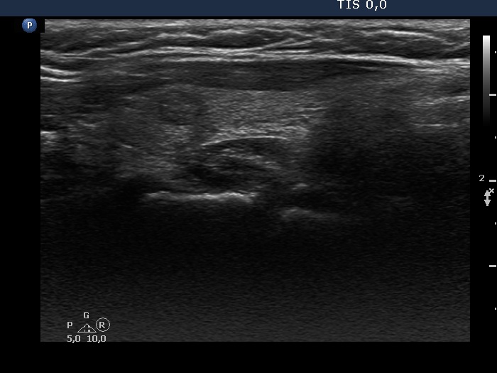 Right lobe, longitudinal scan