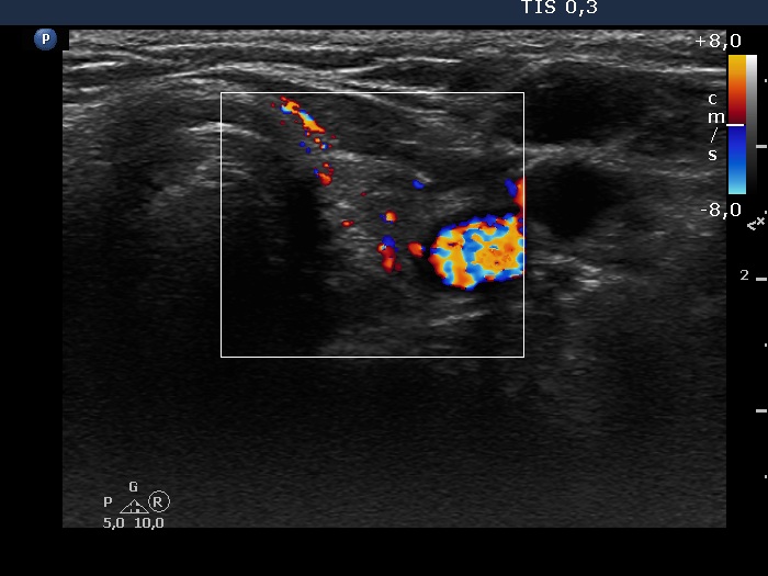 Right lobe, longitudinal scan