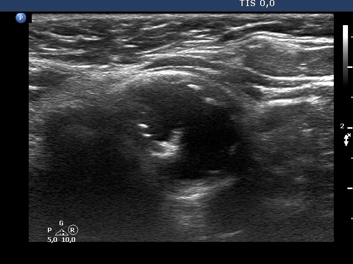 Right lobe, longitudinal scan