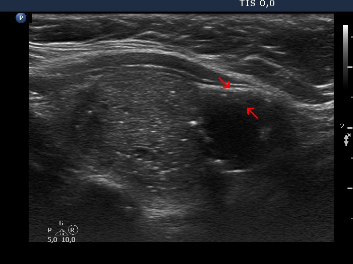 Right lobe, longitudinal scan