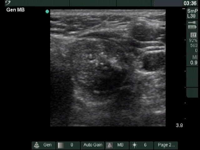Right lobe, longitudinal scan