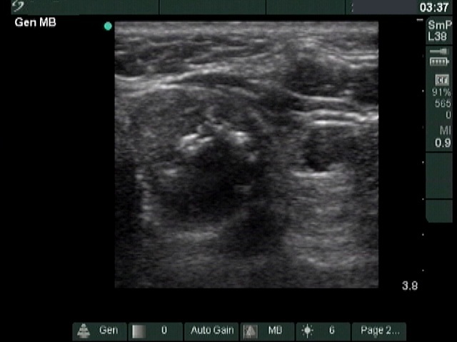 Right lobe, longitudinal scan