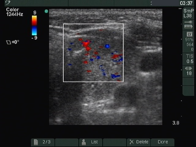 Right lobe, longitudinal scan