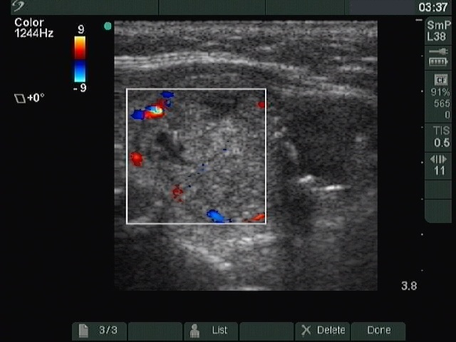 Right lobe, longitudinal scan
