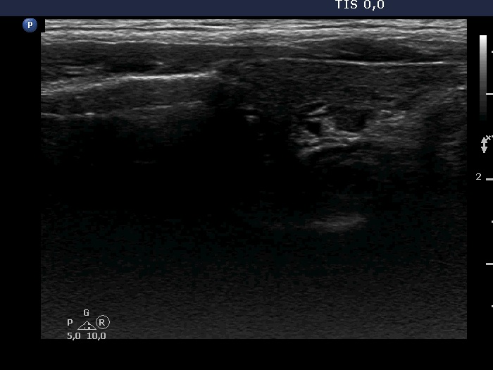Right lobe, longitudinal scan