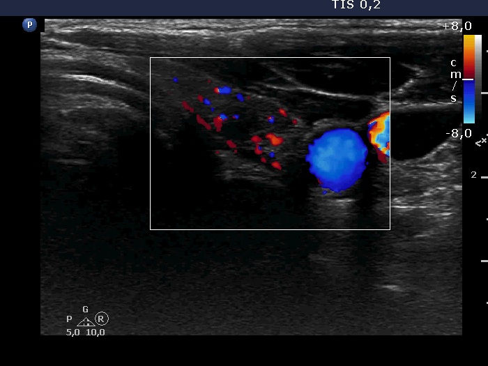Right lobe, longitudinal scan