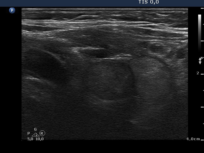 Right lobe, longitudinal scan