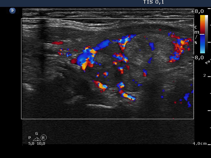 Right lobe, longitudinal scan