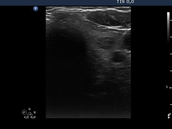 Right lobe, longitudinal scan