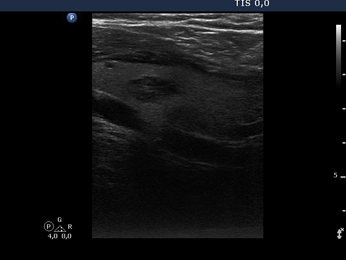 Right lobe, longitudinal scan