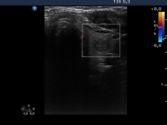 Right lobe, longitudinal scan