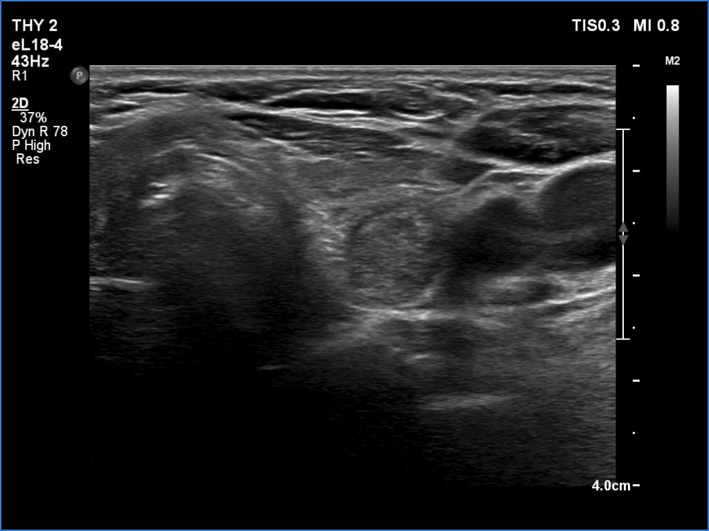 Right lobe, longitudinal scan
