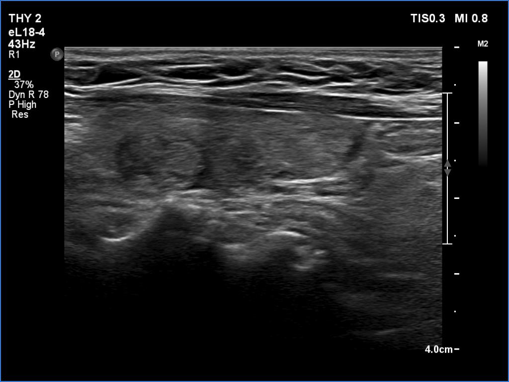 Right lobe, longitudinal scan