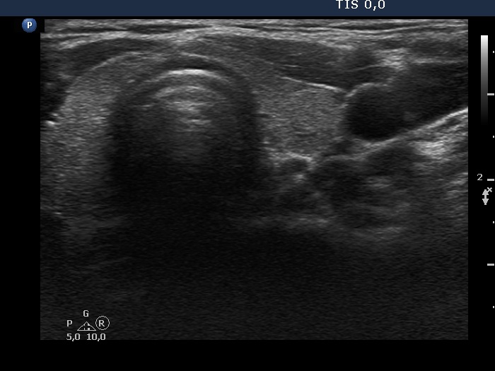 Right lobe, longitudinal scan