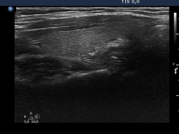 Right lobe, longitudinal scan