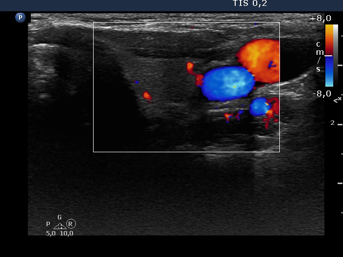 Right lobe, longitudinal scan