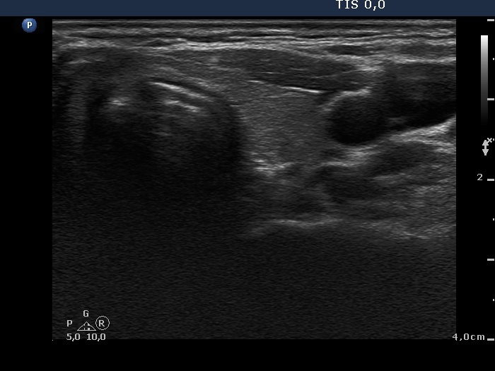 Right lobe, longitudinal scan