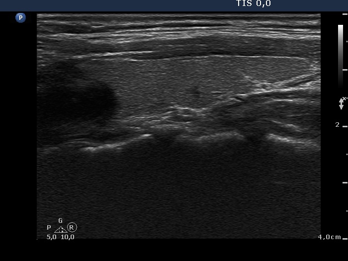 Right lobe, longitudinal scan