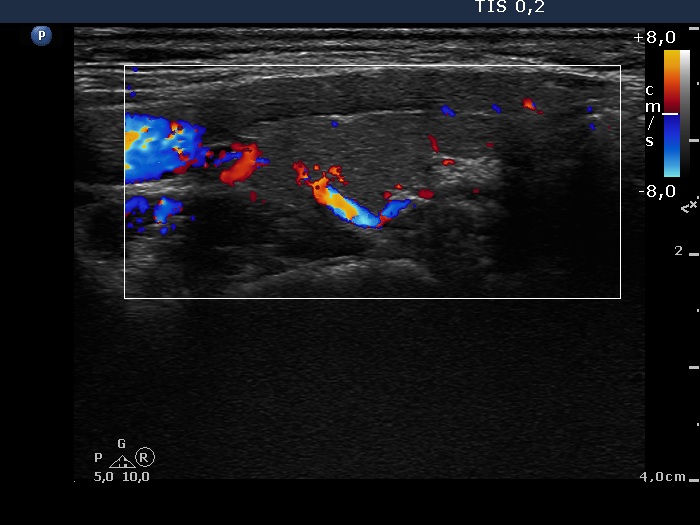 Right lobe, longitudinal scan