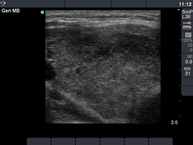 Right lobe, horizontal view