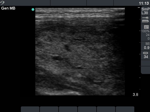 Right lobe, horizontal view