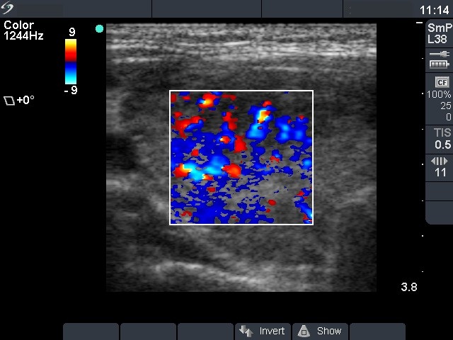 Right lobe, horizontal view