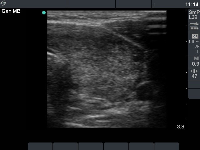 Right lobe, horizontal view