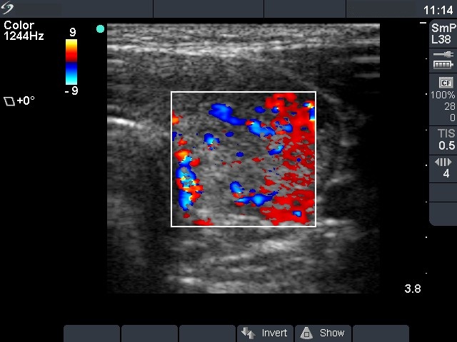 Right lobe, horizontal view