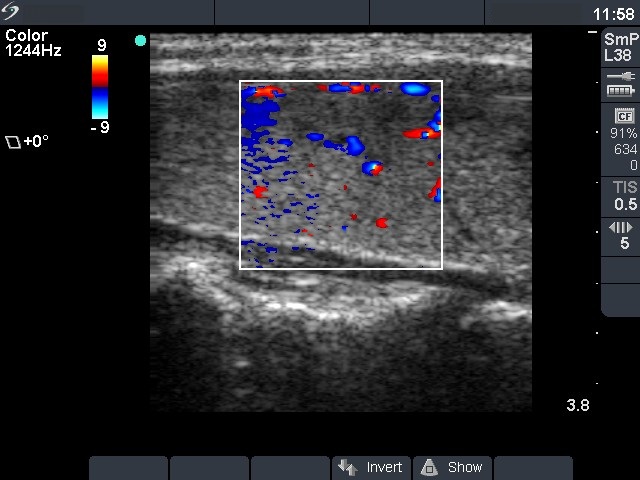 Right lobe, longitudinal scan