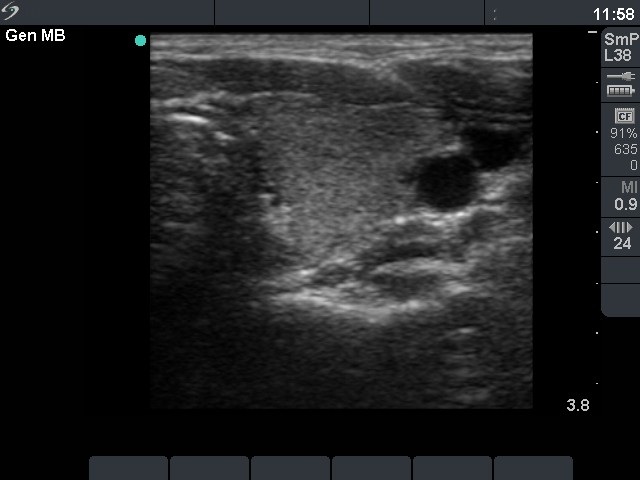 Right lobe, longitudinal scan