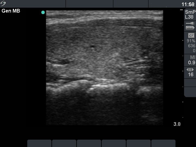 Right lobe, longitudinal scan