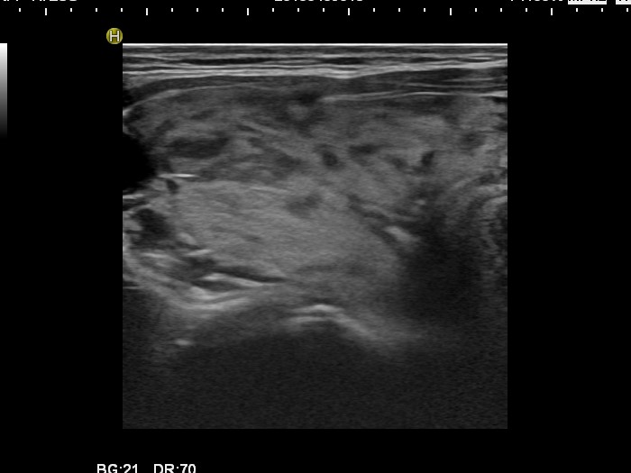 Right lobe, longitudinal scan