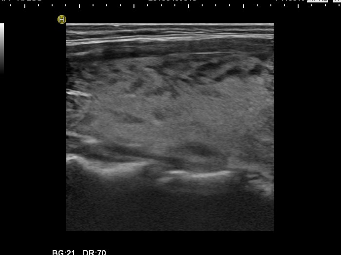 Right lobe, longitudinal scan