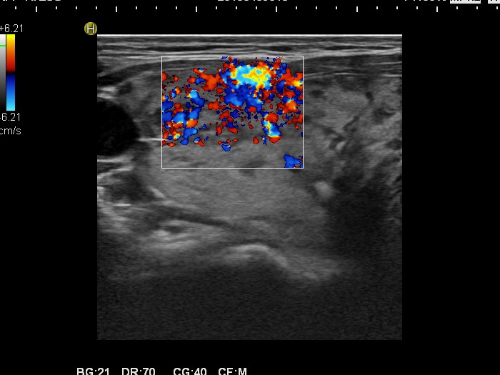 Right lobe, longitudinal scan