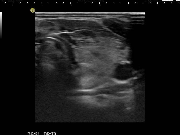 Right lobe, longitudinal scan