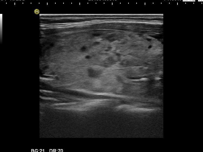 Right lobe, longitudinal scan