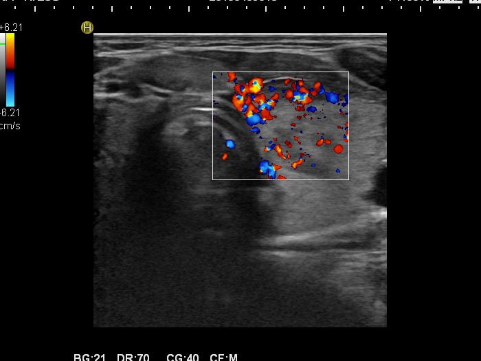 Right lobe, longitudinal scan